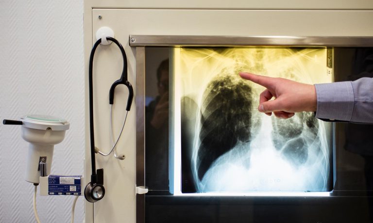 Tuberculosis
